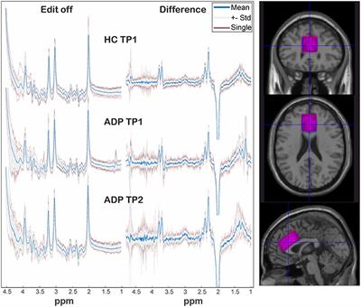 Cortical Glutamate and GABA Changes During Early Abstinence in Alcohol Dependence and Their Associations With Benzodiazepine Medication